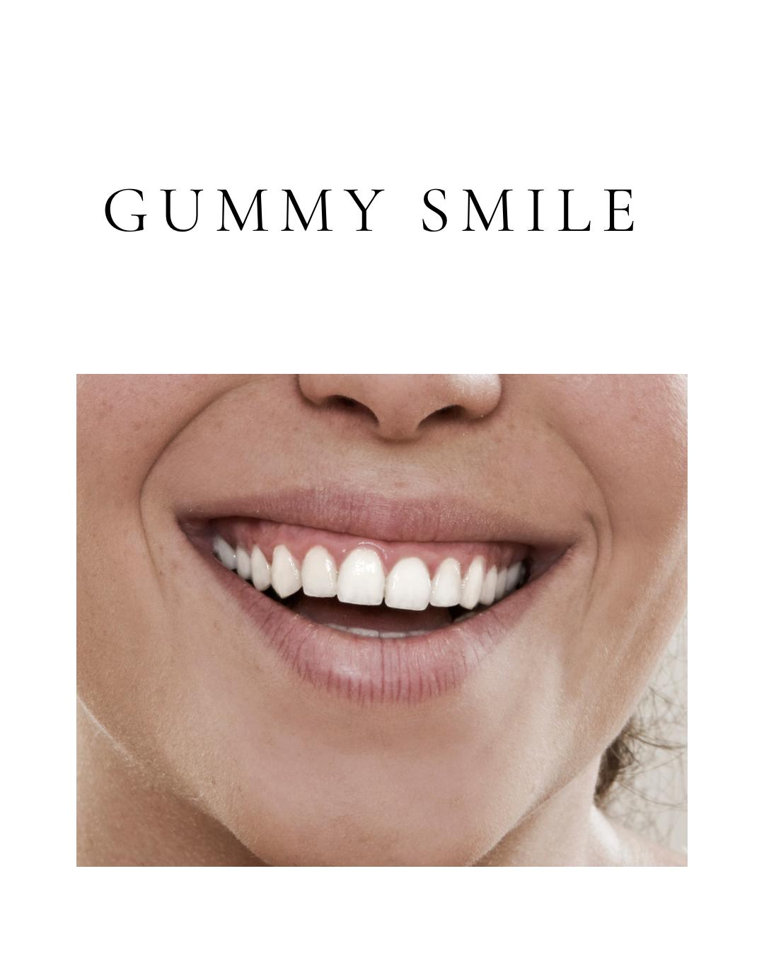 Gummy Smile